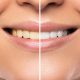 Skuteczne wybielanie zębów domowymi sposobami albo lampą beyound